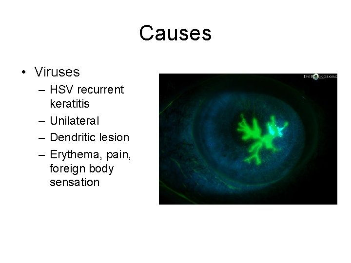 Causes • Viruses – HSV recurrent keratitis – Unilateral – Dendritic lesion – Erythema,