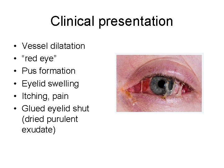 Clinical presentation • • • Vessel dilatation “red eye” Pus formation Eyelid swelling Itching,