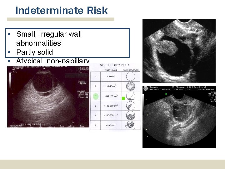 Indeterminate Risk • Small, irregular wall abnormalities • Partly solid • Atypical, non-papillary projections Indeterminate Risk • Small, irregular wall abnormalities • Partly solid • Atypical, non-papillary projections
