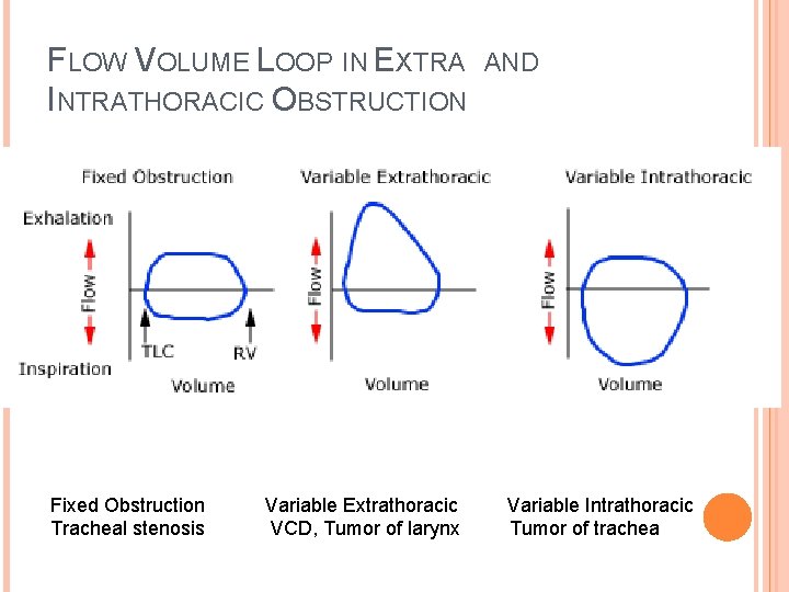 FLOW VOLUME LOOP IN EXTRA INTRATHORACIC OBSTRUCTION Fixed Obstruction Tracheal stenosis Variable Extrathoracic VCD,