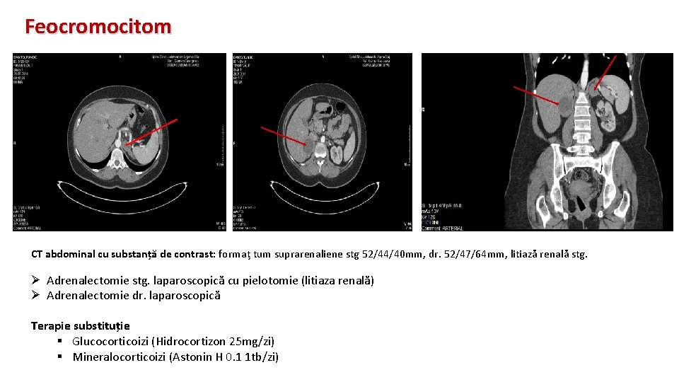Feocromocitom CT abdominal cu substanță de contrast: formaț tum suprarenaliene stg 52/44/40 mm, dr.