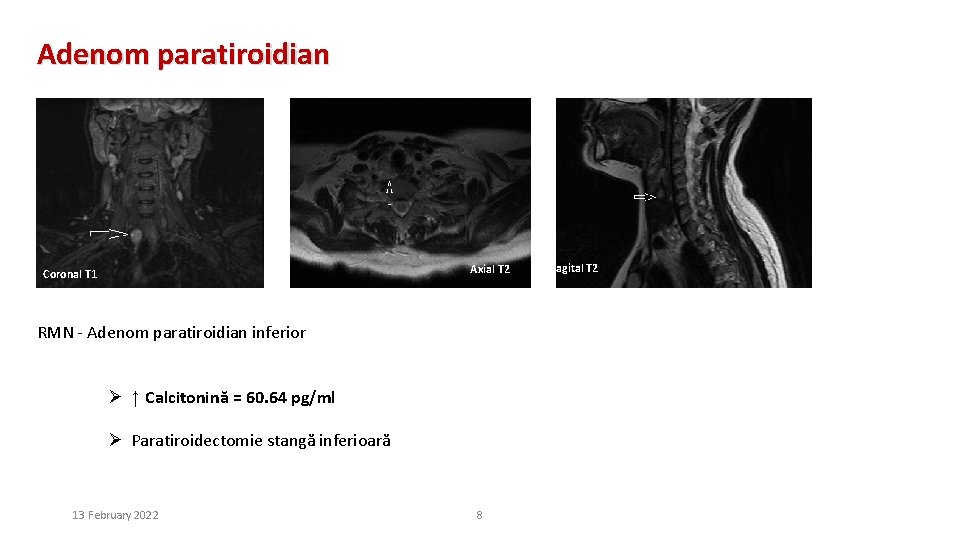 Adenom paratiroidian Axial T 2 Coronal T 1 RMN - Adenom paratiroidian inferior Ø