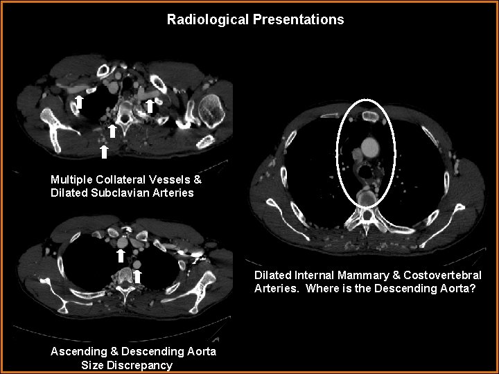 Radiological Presentations Multiple Collateral Vessels & Dilated Subclavian Arteries Dilated Internal Mammary & Costovertebral