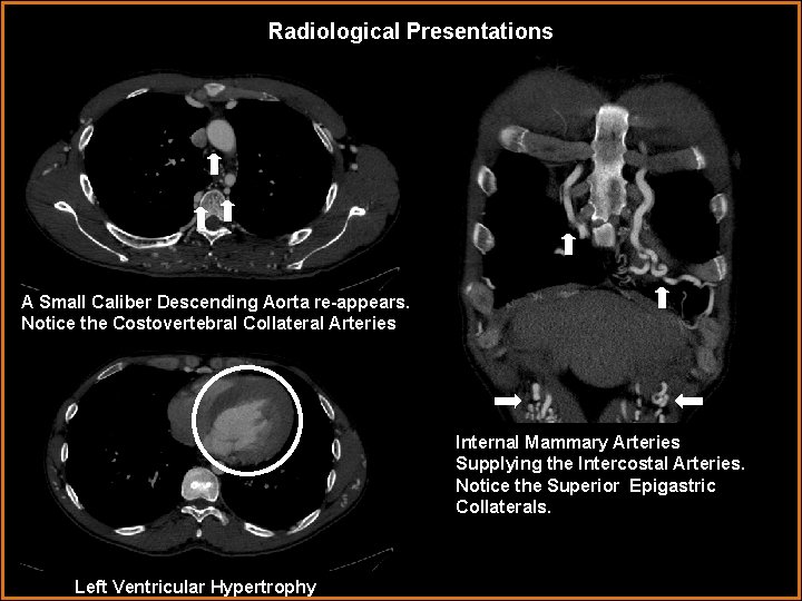 Radiological Presentations A Small Caliber Descending Aorta re-appears. Notice the Costovertebral Collateral Arteries Internal