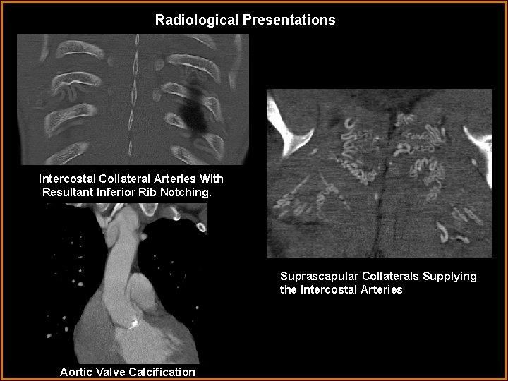 Radiological Presentations Intercostal Collateral Arteries With Resultant Inferior Rib Notching. Suprascapular Collaterals Supplying the
