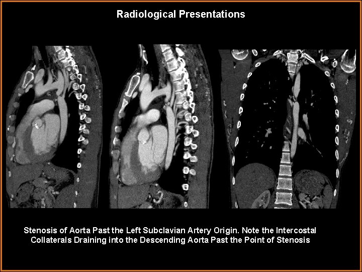 Radiological Presentations Stenosis of Aorta Past the Left Subclavian Artery Origin. Note the Intercostal