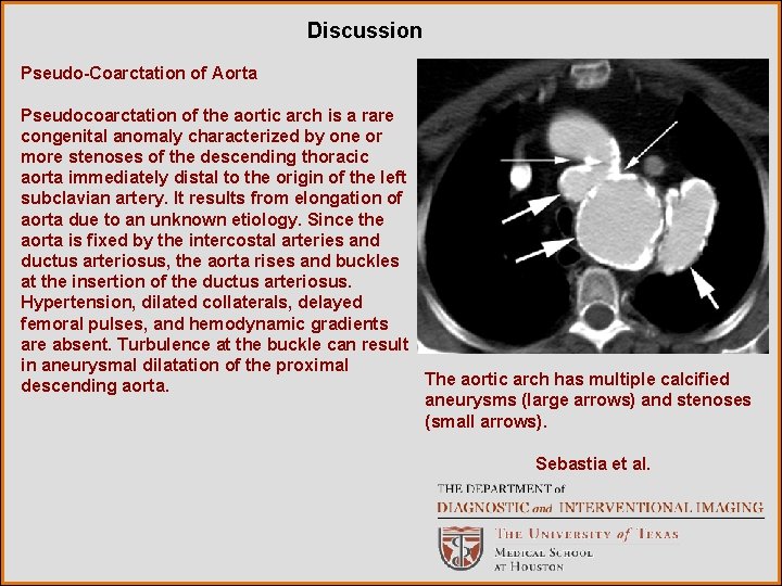 Discussion Pseudo-Coarctation of Aorta Pseudocoarctation of the aortic arch is a rare congenital anomaly