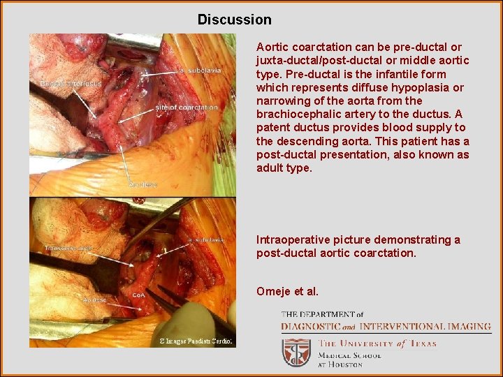 Discussion Aortic coarctation can be pre-ductal or juxta-ductal/post-ductal or middle aortic type. Pre-ductal is