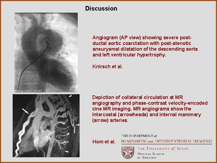 Discussion Angiogram (AP view) showing severe postductal aortic coarctation with post-stenotic aneurysmal dilatation of