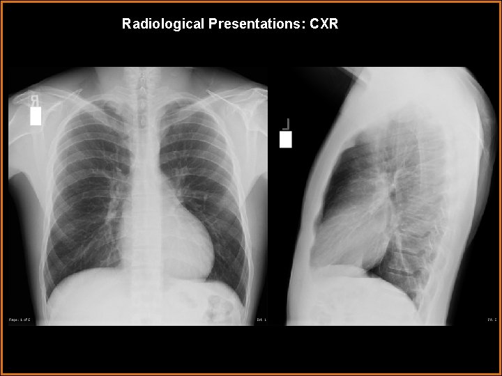 Radiological Presentations: CXR 