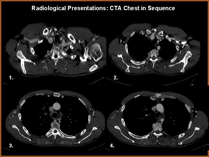 Radiological Presentations: CTA Chest in Sequence 1. 3. 2. 4. 