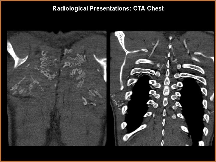 Radiological Presentations: CTA Chest 