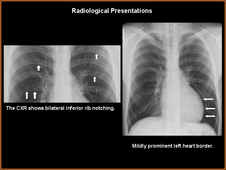 Radiological Presentations . The CXR shows bilateral inferior rib notching. Mildly prominent left heart