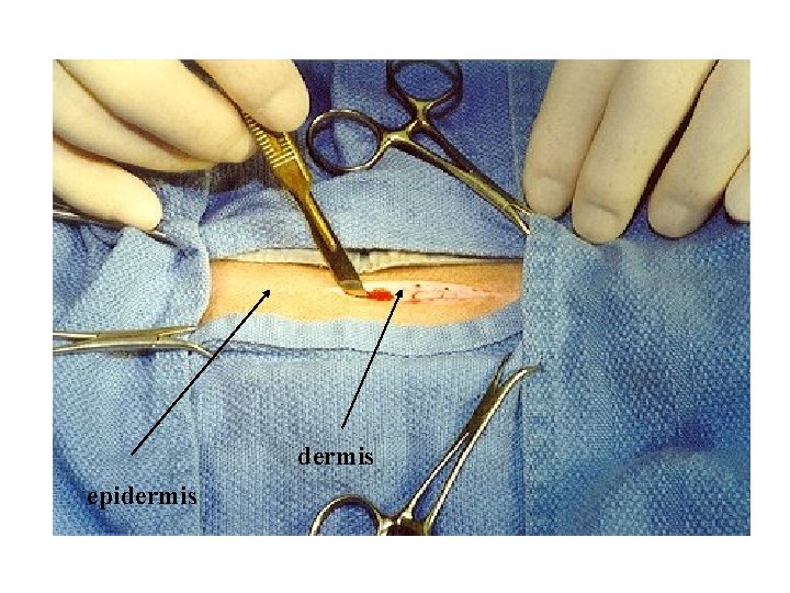 dermis epidermis 
