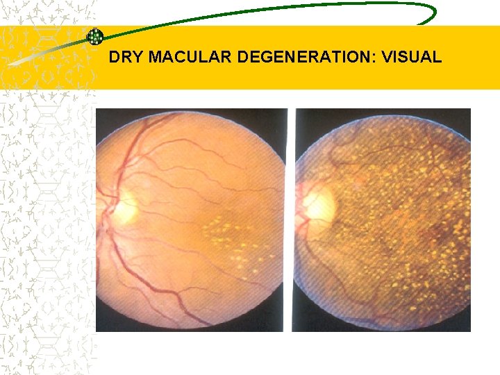 DRY MACULAR DEGENERATION: VISUAL 