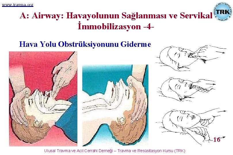 www. travma. org A: Airway: Havayolunun Sağlanması ve Servikal İmmobilizasyon -4 Hava Yolu Obstrüksiyonunu