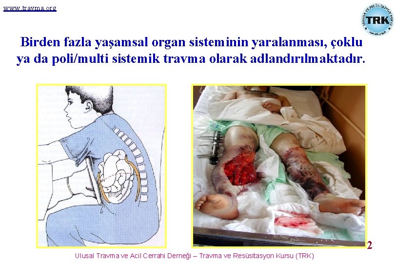 www. travma. org Birden fazla yaşamsal organ sisteminin yaralanması, çoklu ya da poli/multi sistemik
