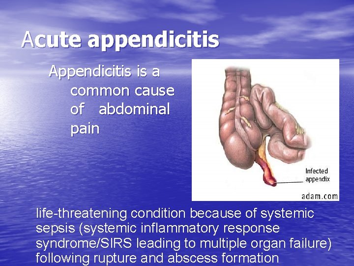 Acute appendicitis Appendicitis is a common cause of abdominal pain life-threatening condition because of