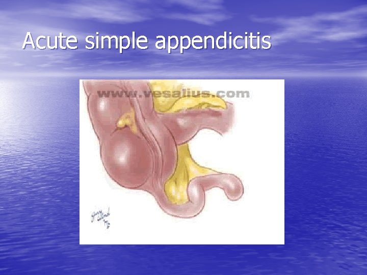 Acute simple appendicitis 