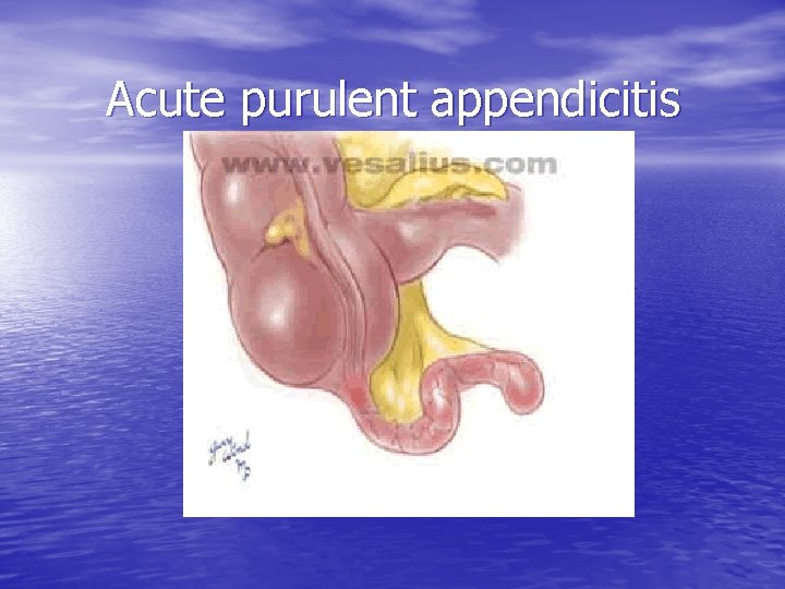 Acute purulent appendicitis 