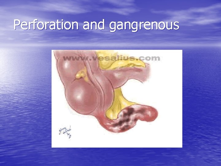Perforation and gangrenous 