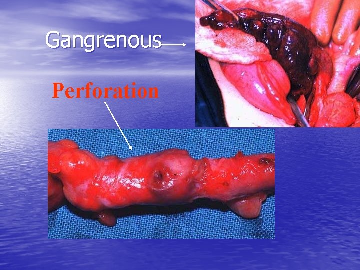 Gangrenous Perforation 