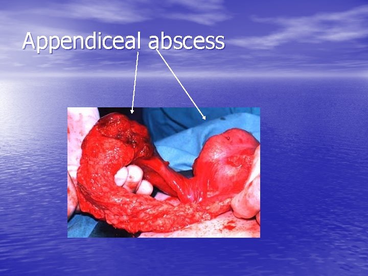 Appendiceal abscess 