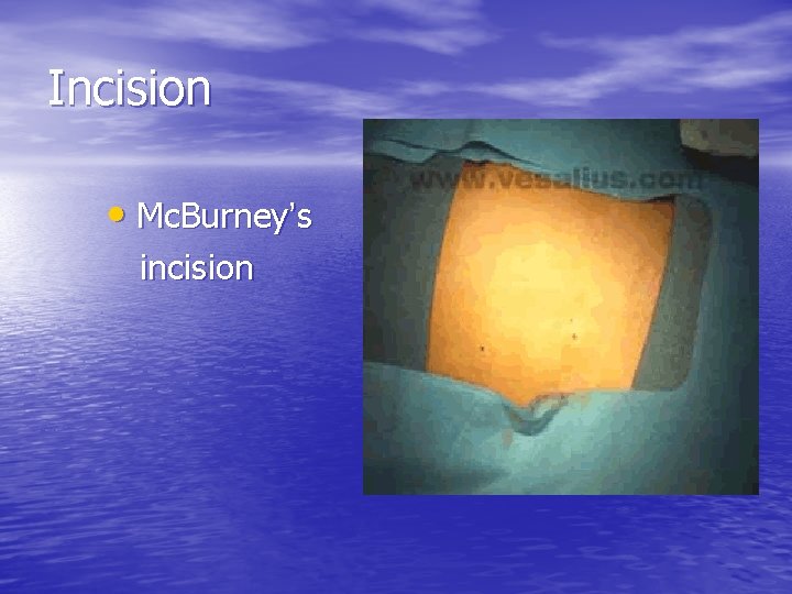 Incision • Mc. Burney’s incision 