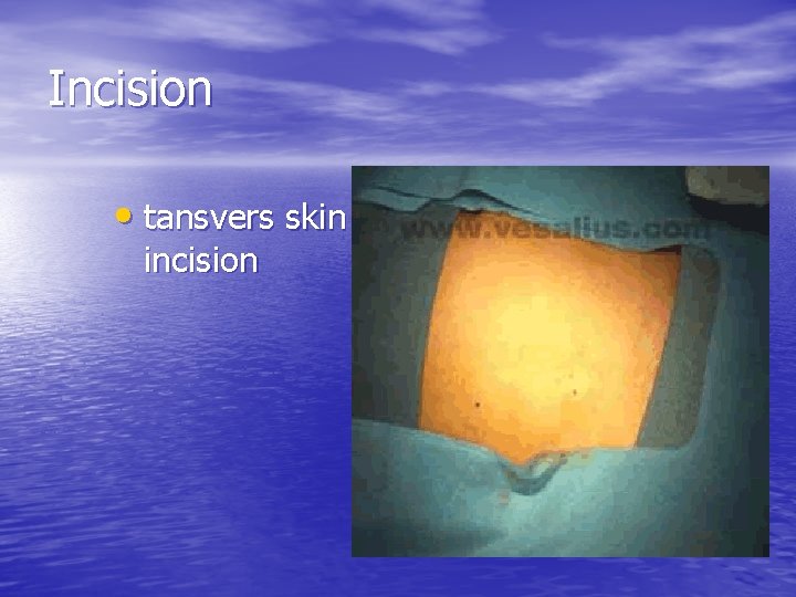 Incision • tansvers skin incision 