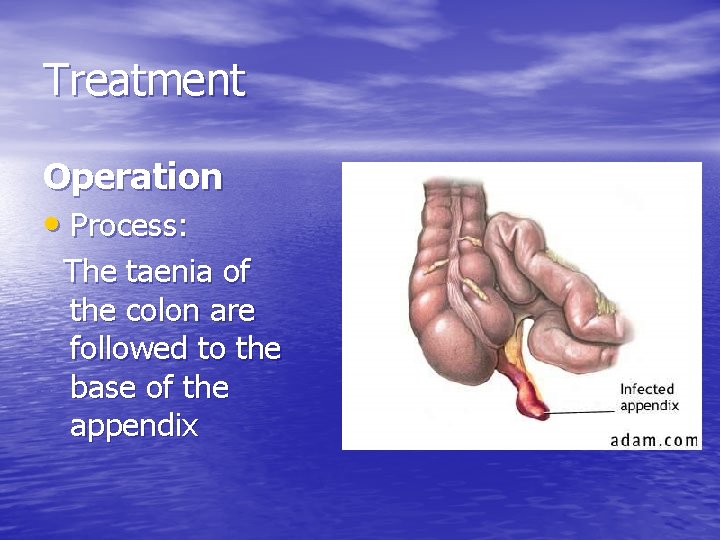 Treatment Operation • Process: The taenia of the colon are followed to the base
