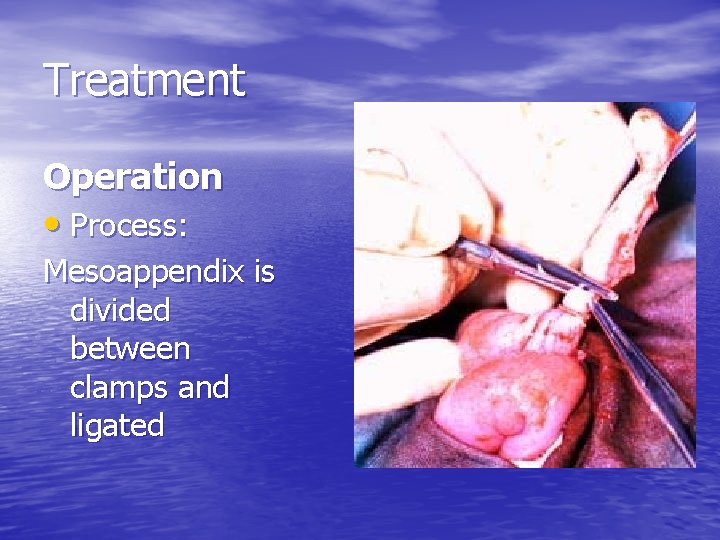 Treatment Operation • Process: Mesoappendix is divided between clamps and ligated 