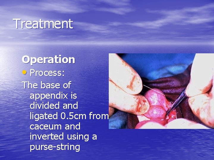 Treatment Operation • Process: The base of appendix is divided and ligated 0. 5