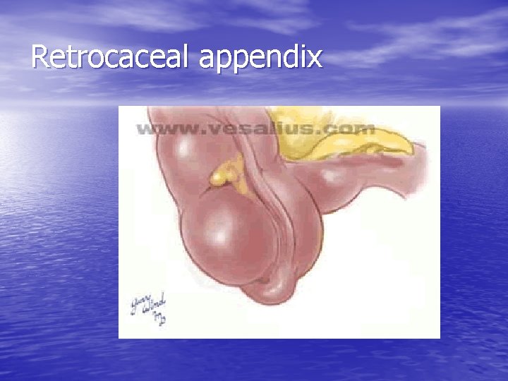 Retrocaceal appendix 