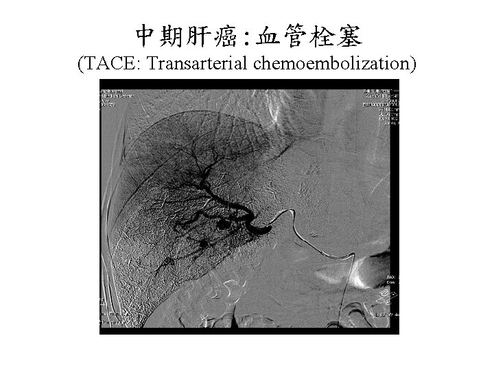 中期肝癌: 血管栓塞 (TACE: Transarterial chemoembolization) 