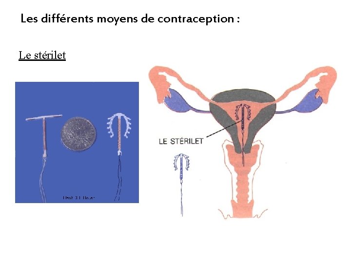 Les différents moyens de contraception : Le stérilet 