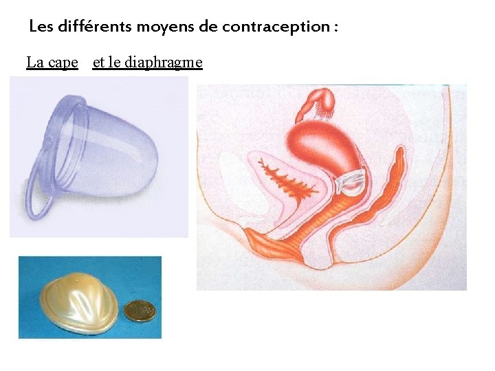 Les différents moyens de contraception : La cape et le diaphragme 