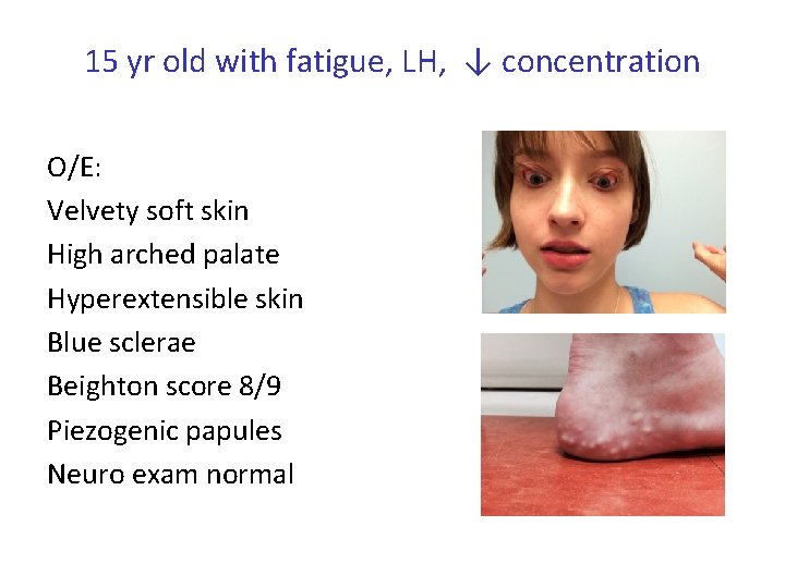 15 yr old with fatigue, LH, ↓ concentration O/E: Velvety soft skin High arched