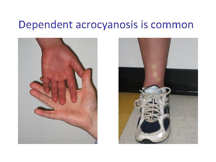 Dependent acrocyanosis is common 