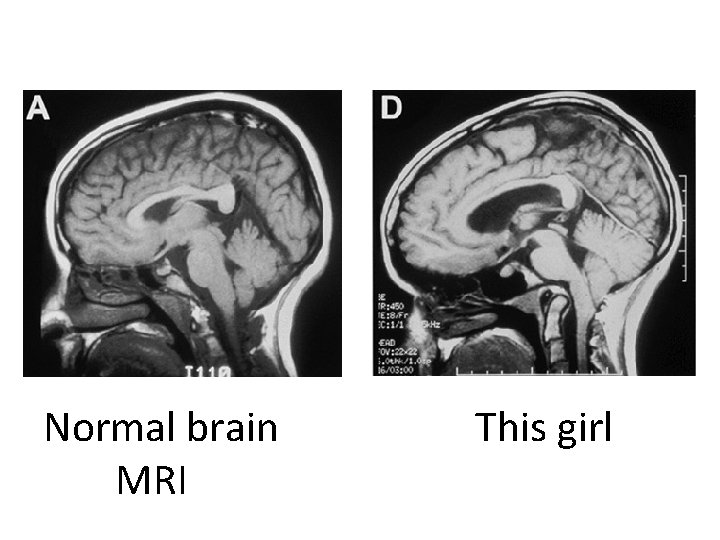 Normal brain MRI This girl 