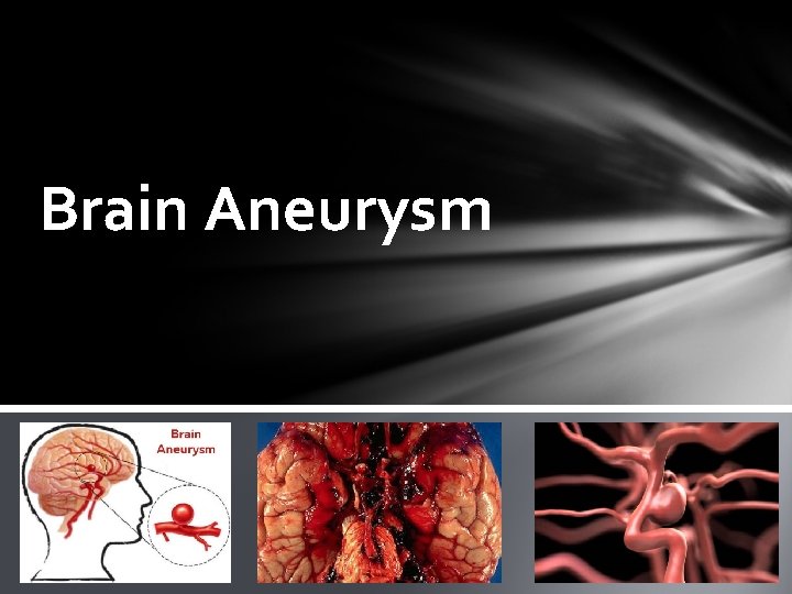 Brain Aneurysm 