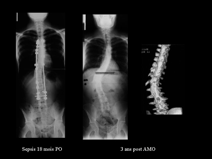 Sepsis 18 mois PO 3 ans post AMO 