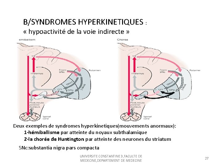 B/SYNDROMES HYPERKINETIQUES : « hypoactivité de la voie indirecte » Deux exemples de syndromes