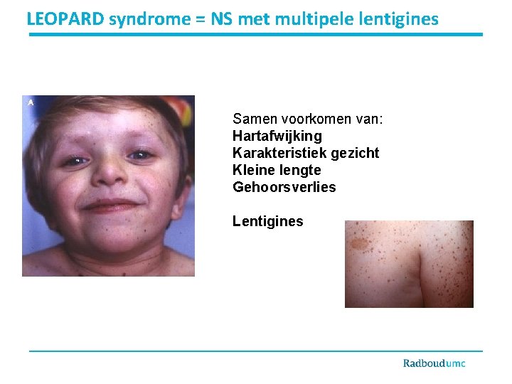 LEOPARD syndrome = NS met multipele lentigines Samen voorkomen van: Hartafwijking Karakteristiek gezicht Kleine