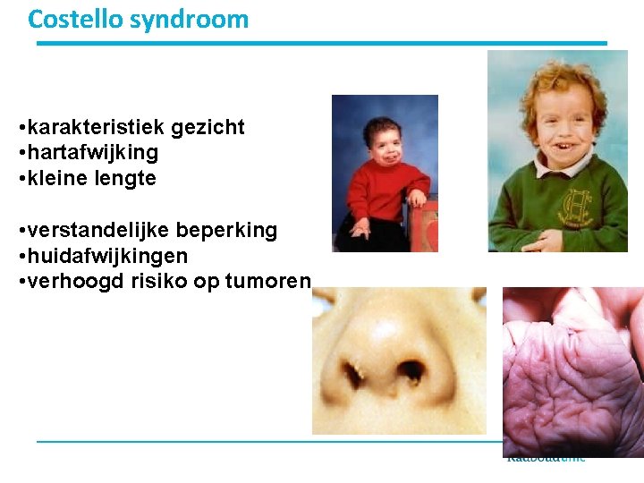 Costello syndroom • karakteristiek gezicht • hartafwijking • kleine lengte • verstandelijke beperking •