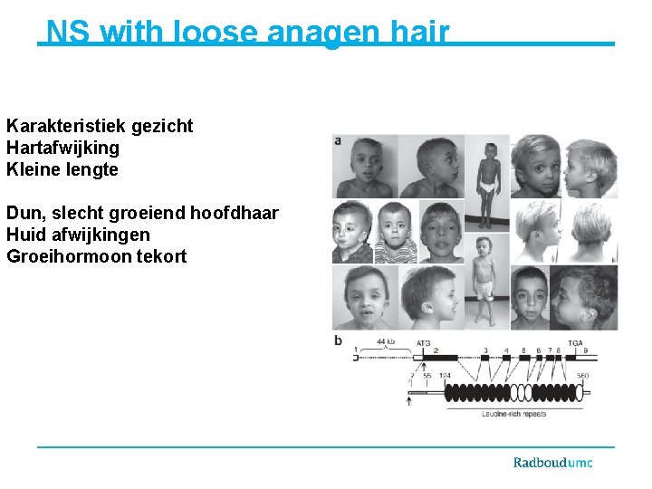 NS with loose anagen hair Karakteristiek gezicht Hartafwijking Kleine lengte Dun, slecht groeiend hoofdhaar