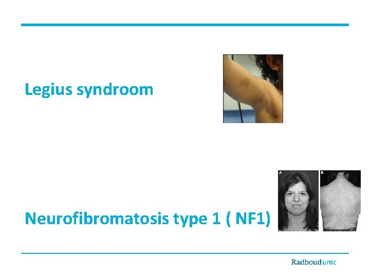 Legius syndroom Neurofibromatosis type 1 ( NF 1) 