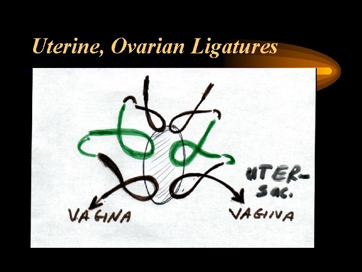 Uterine, Ovarian Ligatures 
