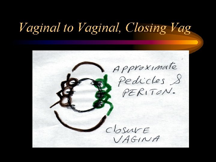 Vaginal to Vaginal, Closing Vag 