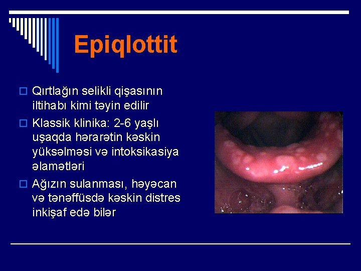 Epiqlottit o Qırtlağın selikli qişasının iltihabı kimi təyin edilir o Klassik klinika: 2 -6