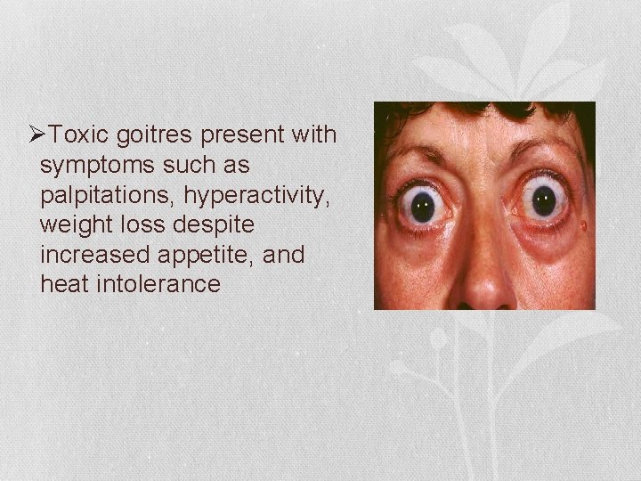 ØToxic goitres present with symptoms such as palpitations, hyperactivity, weight loss despite increased appetite,